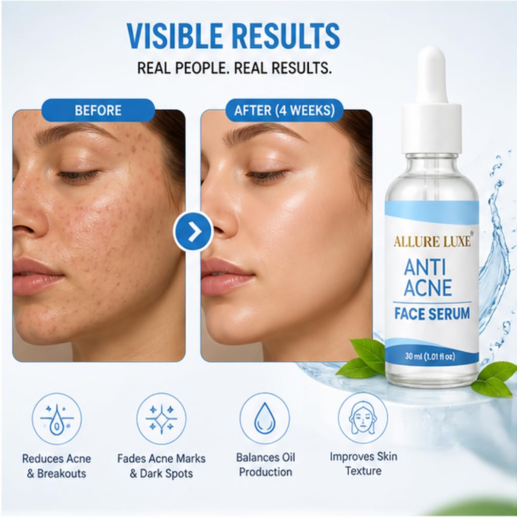 Allure Luxe Anti Acne Face Serum for Clear & Smooth Looking Skin